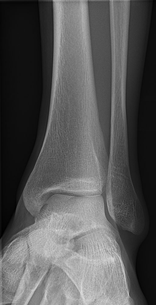 AP mortise radiograph of a normal ankle with the joint space open on all sides.