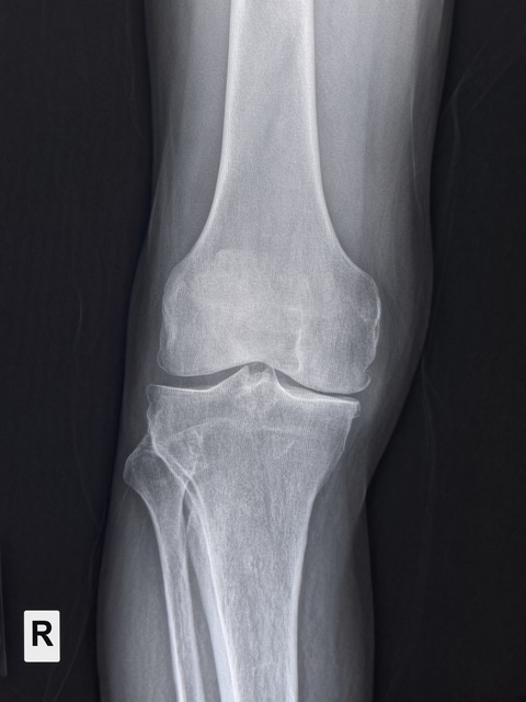 AP knee