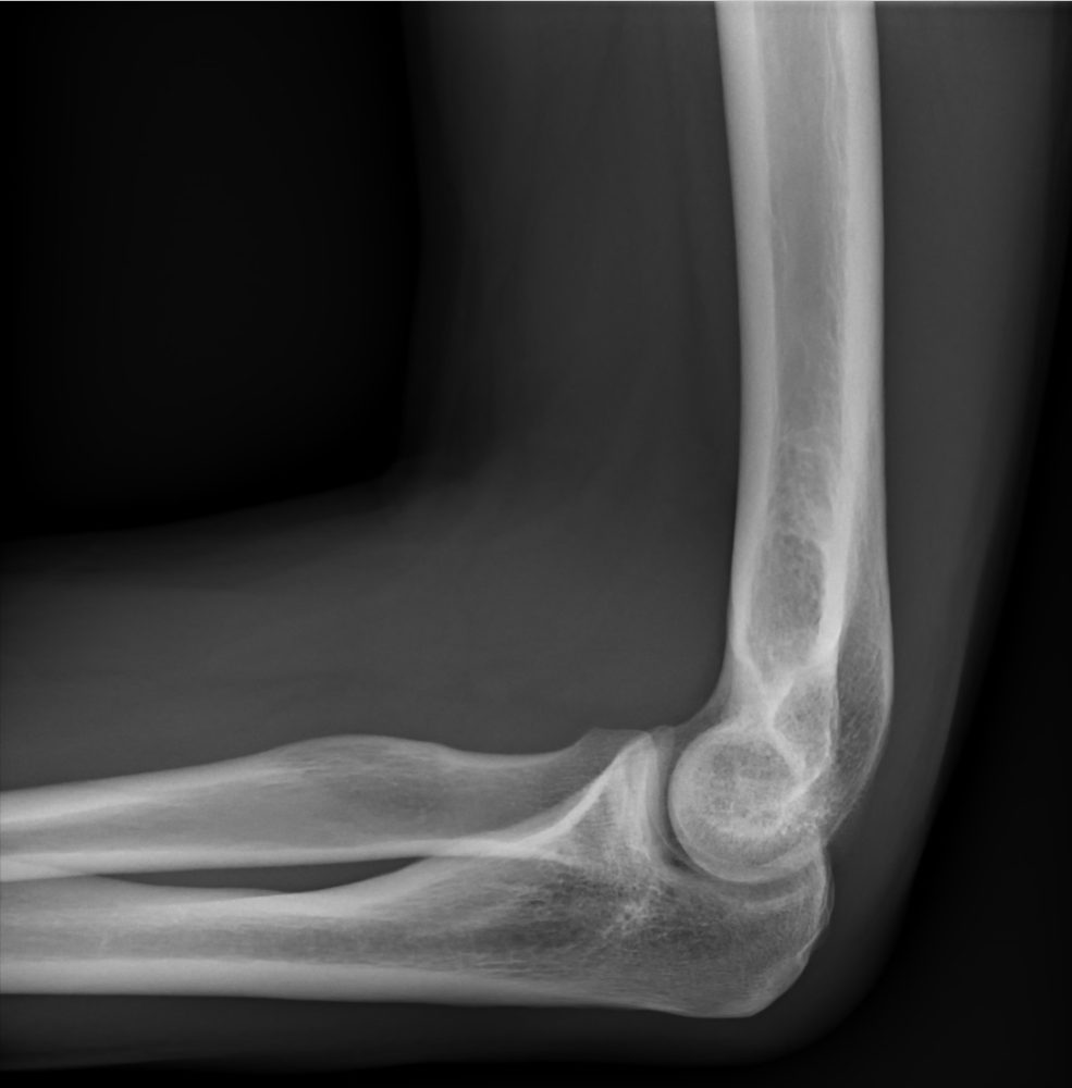 Lateral radiograph of a normal elbow flexed 90 degrees.