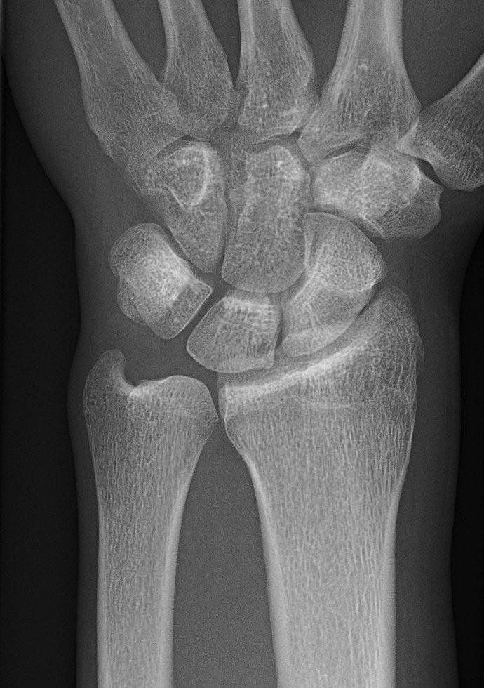 PA radiograph of a normal wrist.