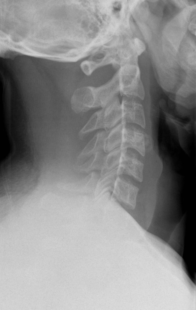 Lateral radiograph of a normal cervical spine.