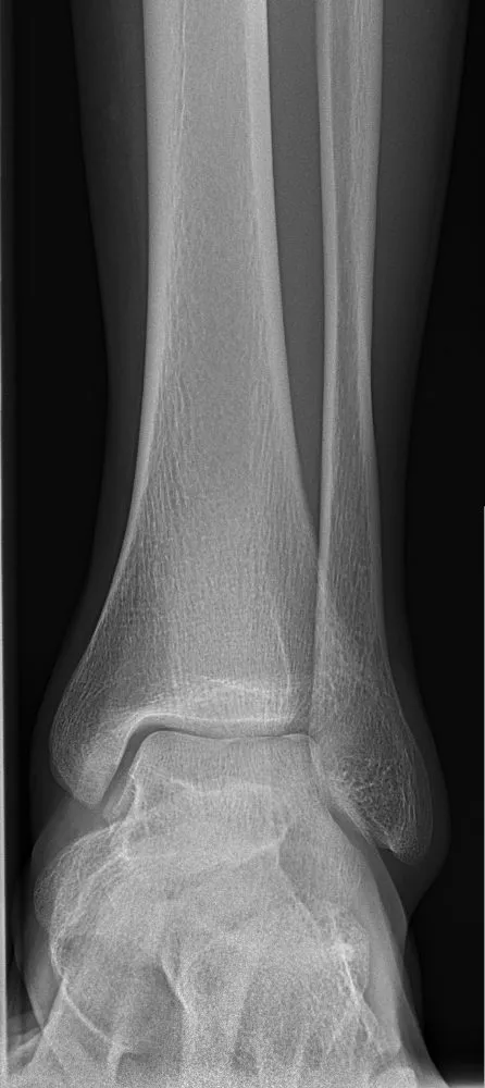 Normal AP ankle with the medial mortise open and the fibula overlapping the talus laterally.
