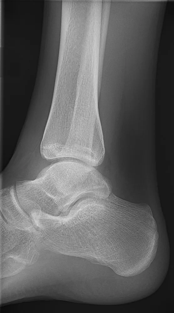 Normal lateral ankle with an open tibiotalar joint and the fibula over the back of the tibia.