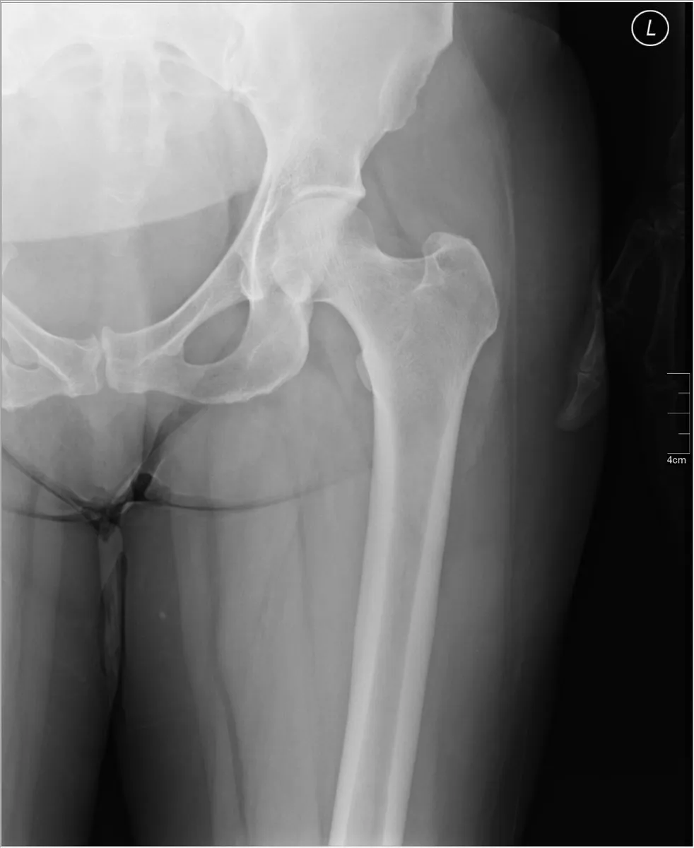 AP of the proximal femur including the hip joint.