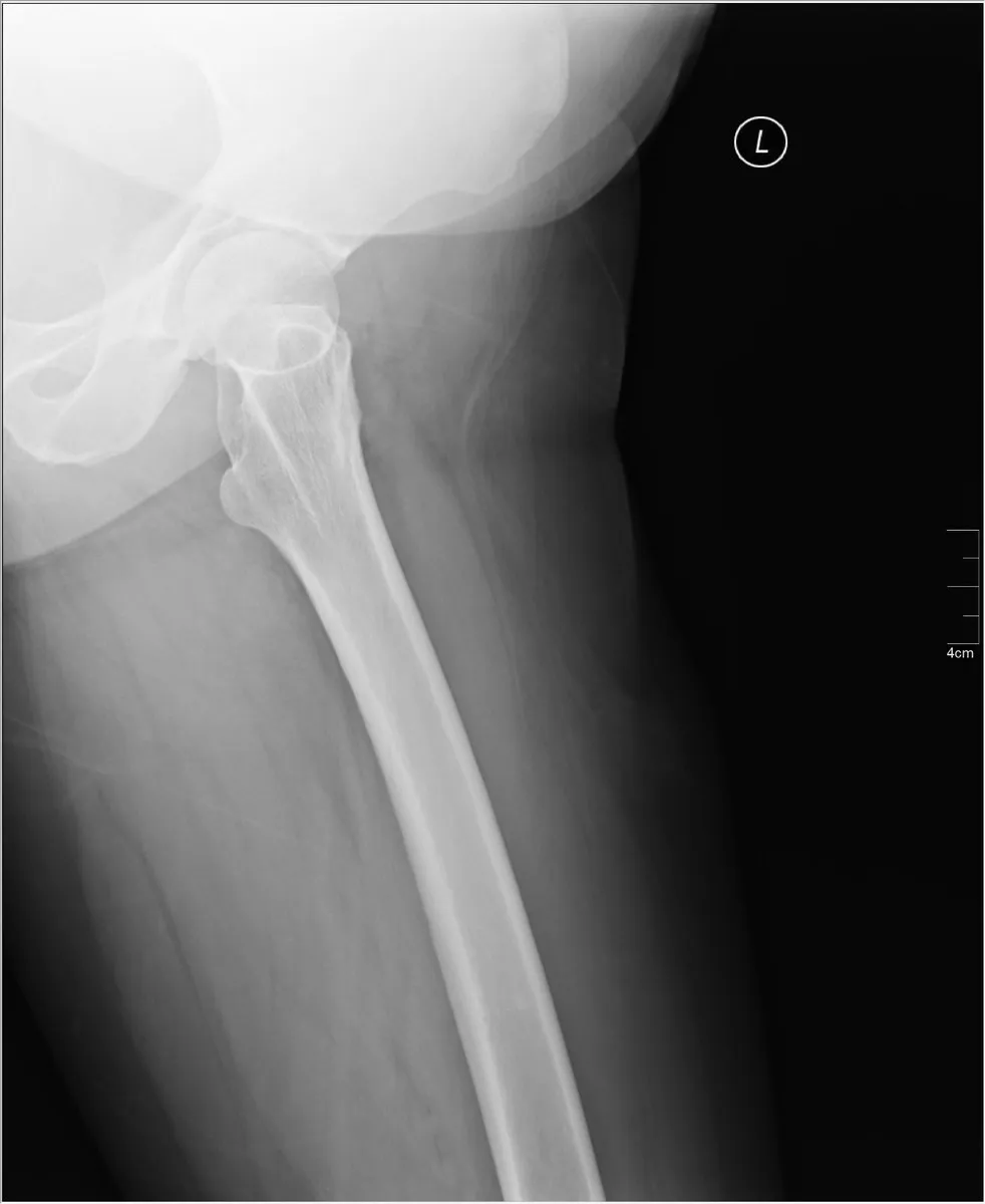 Lateral of the proximal femur including the hip.