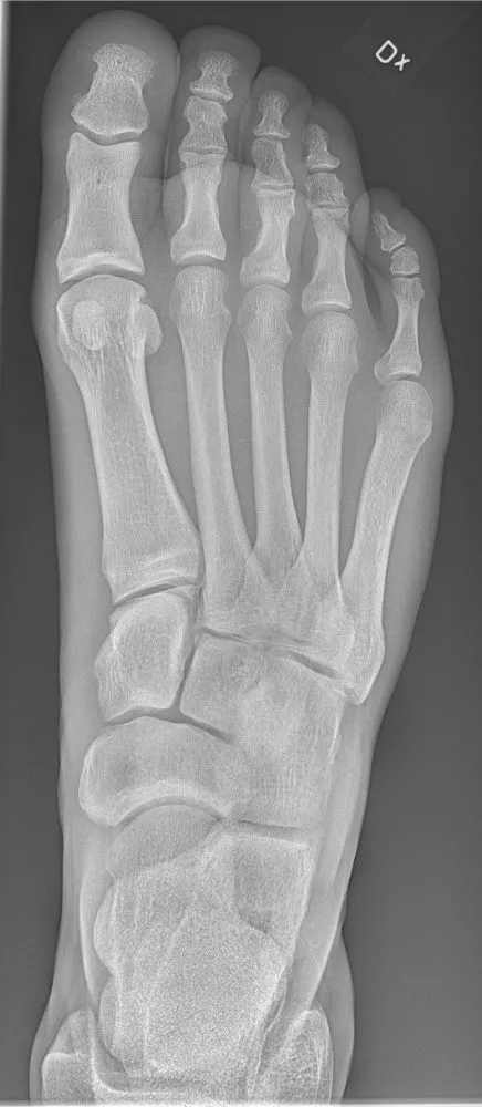Normal AP foot with open tarsometatarsal joints and even metatarsal spacing.