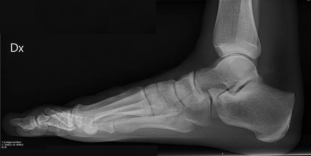 Normal lateral foot with the metatarsals superimposed and the ankle joint included.