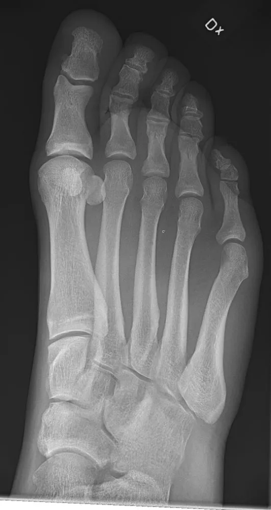 Normal medial oblique foot with the bases of the 3rd to 5th metatarsals free of overlap.