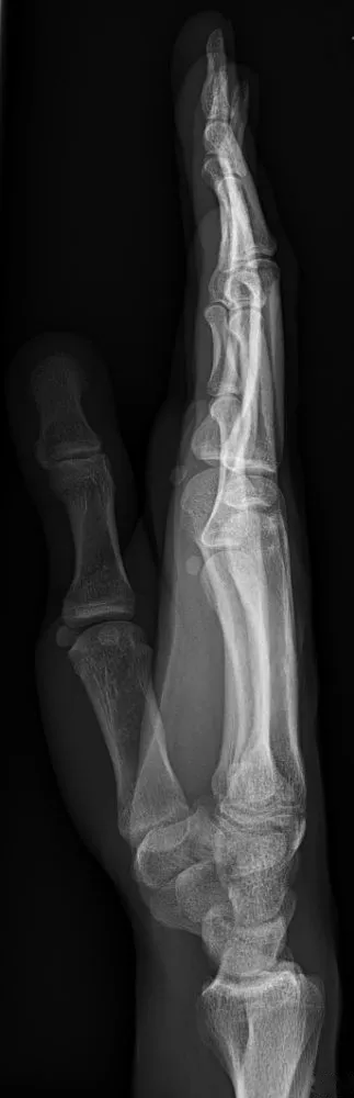 Normal lateral hand with the fingers extended and superimposed and the thumb free.