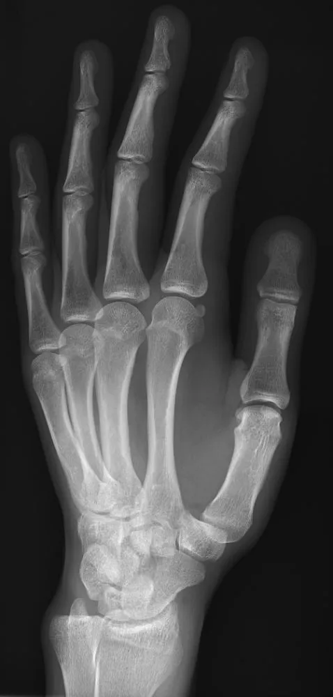 Normal PA oblique hand with the metacarpal shafts separated.