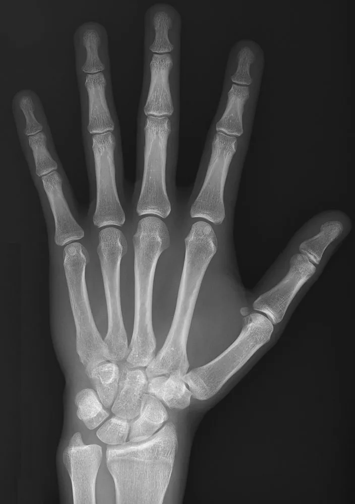 Normal PA hand with straight, slightly spread fingers and open joints.