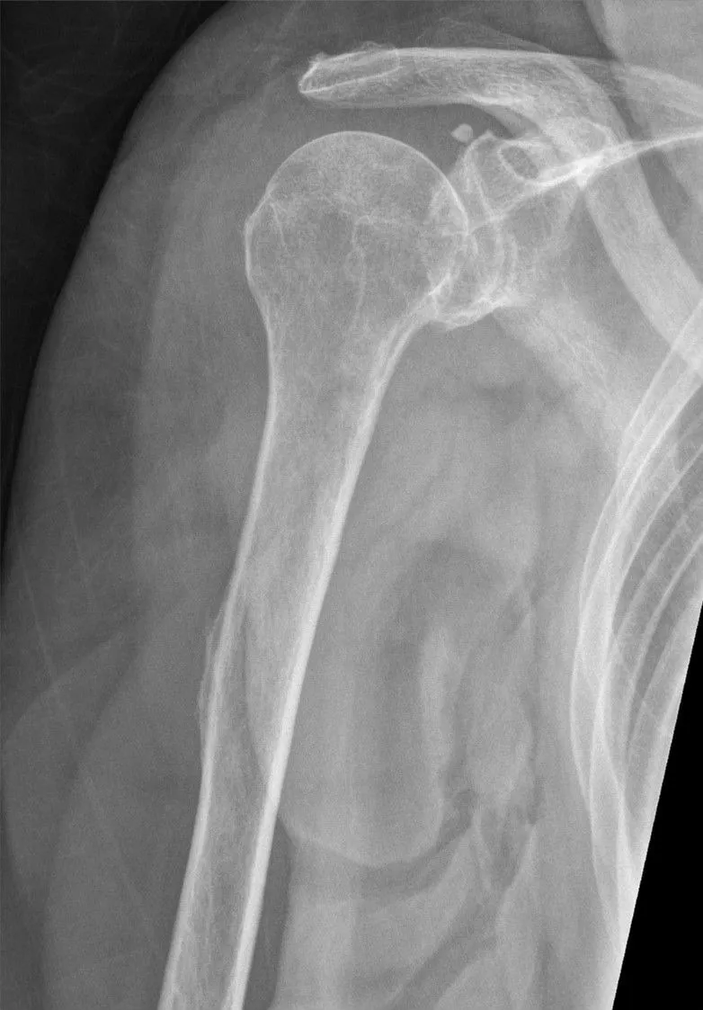 AP humerus with the greater tubercle in profile and the shoulder joint included.