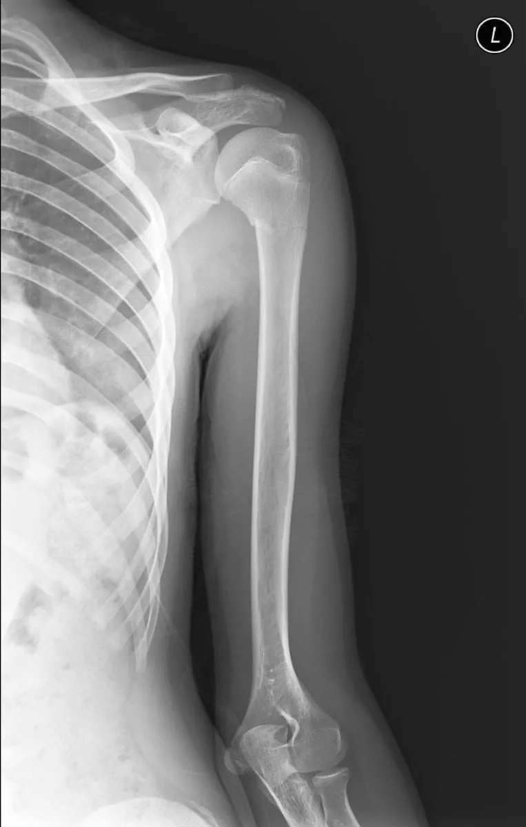 Lateral humerus including the shoulder and the elbow.