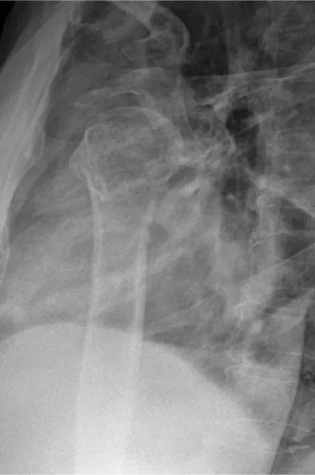 Transthoracic lateral of the proximal humerus seen through the chest.