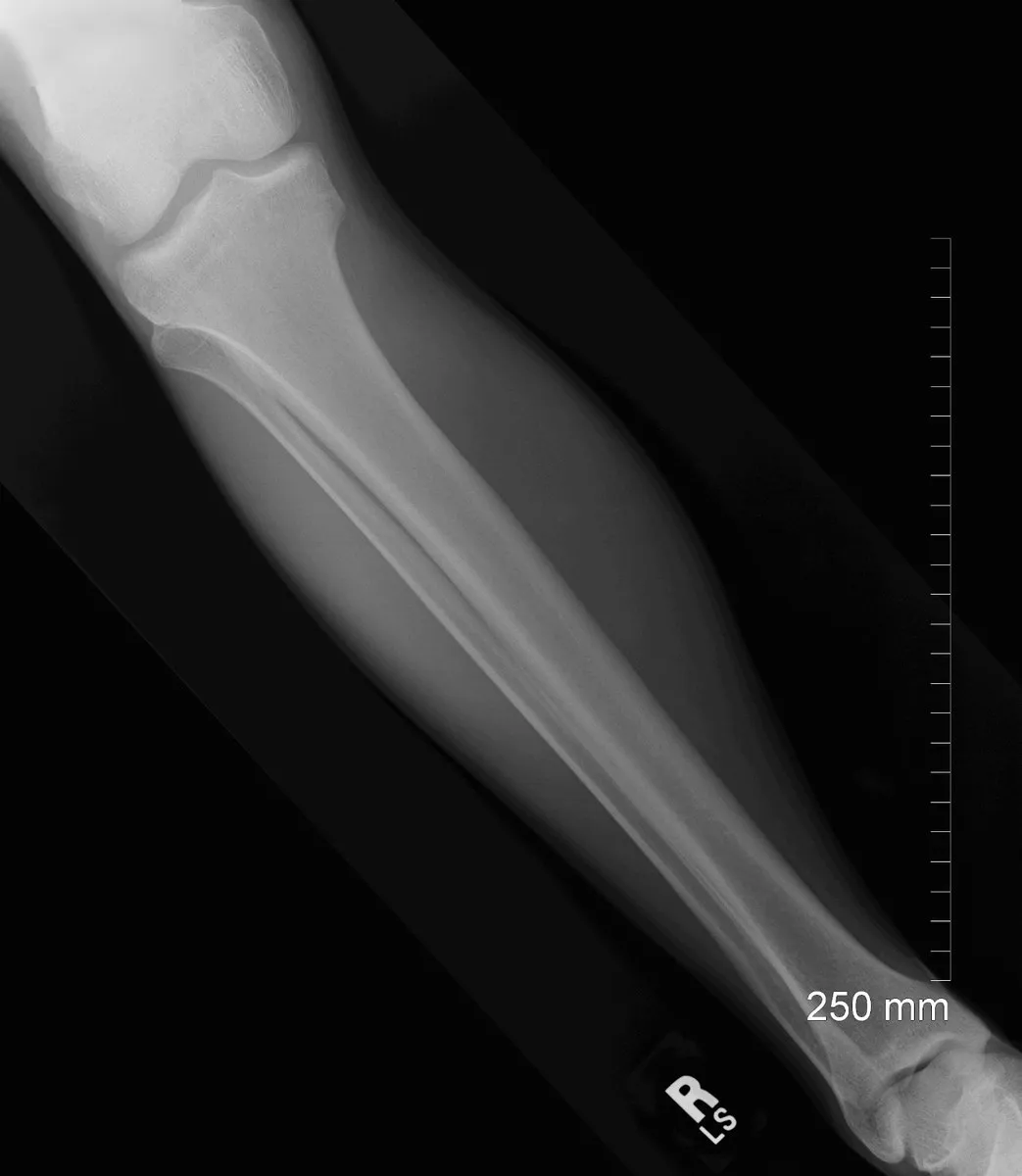 AP lower leg placed diagonally on the IR to include the knee and the ankle.