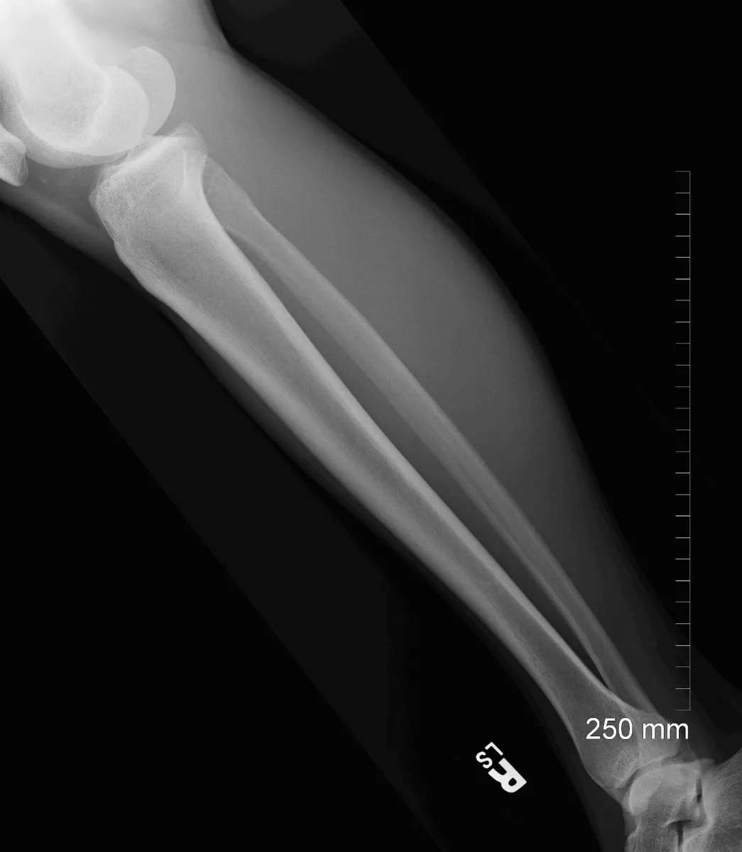 Lateral lower leg including the knee and the ankle.