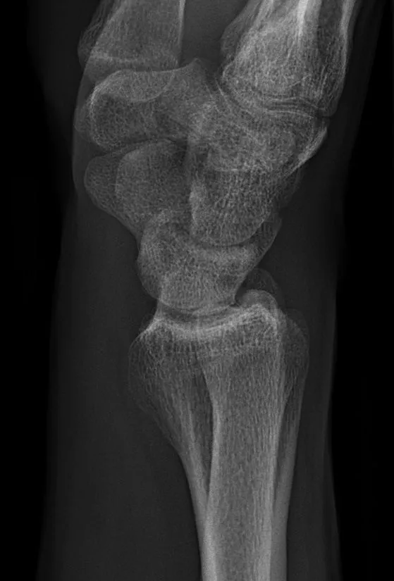 Normal lateral wrist with the distal radius and ulna superimposed.