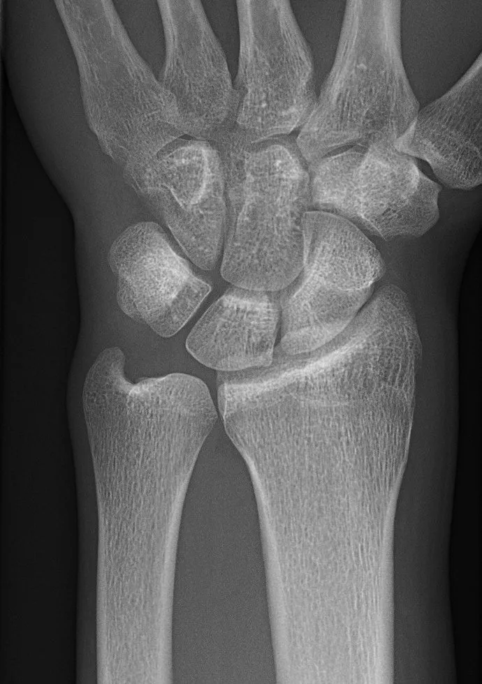 Normal PA wrist with an open distal radioulnar joint and evenly spaced carpals.