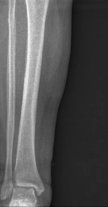 Lower leg radiograph with a grainy, noisy appearance.