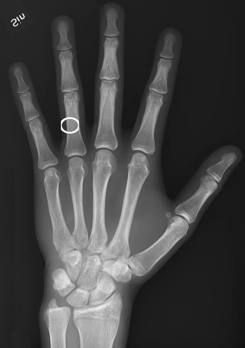 PA hand with a ring over the proximal phalanx of a finger.