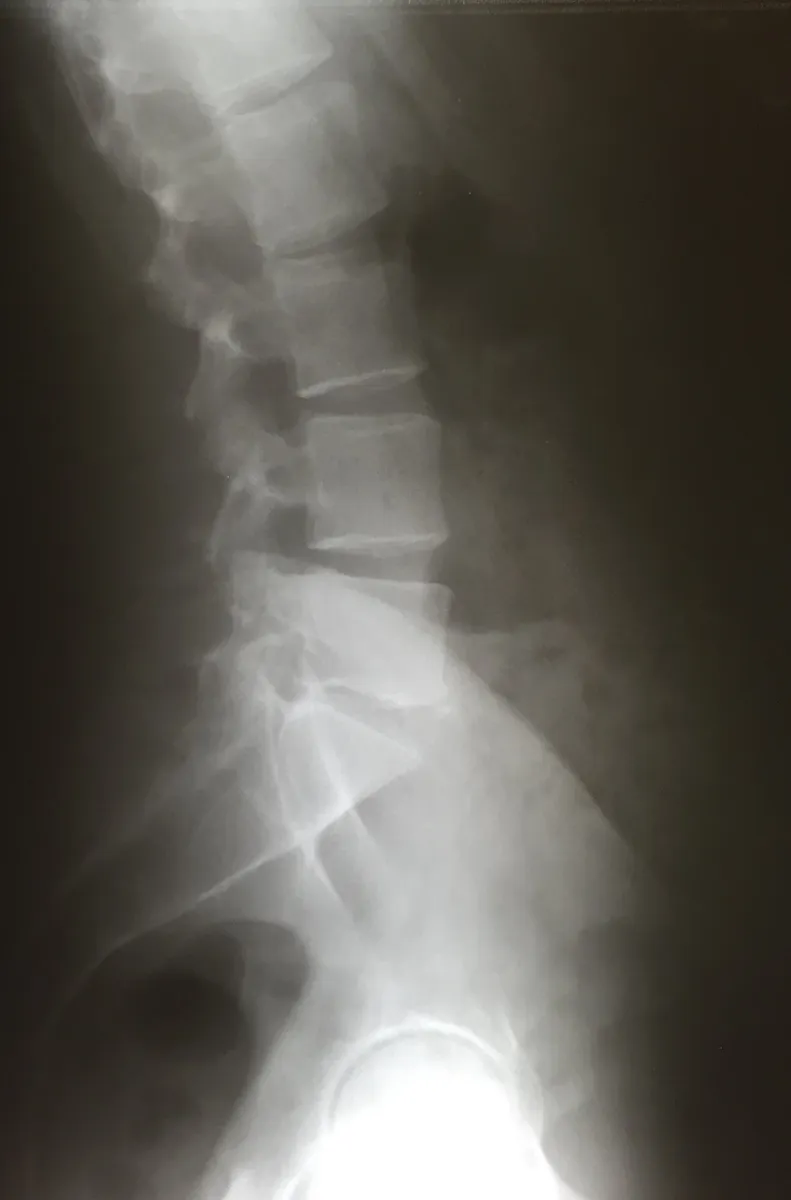 Lateral lumbar spine with open disc spaces.