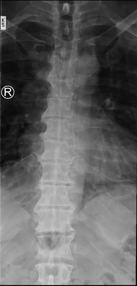 AP thoracic spine with the spinous processes in the midline from the upper to the lower thoracic spine.