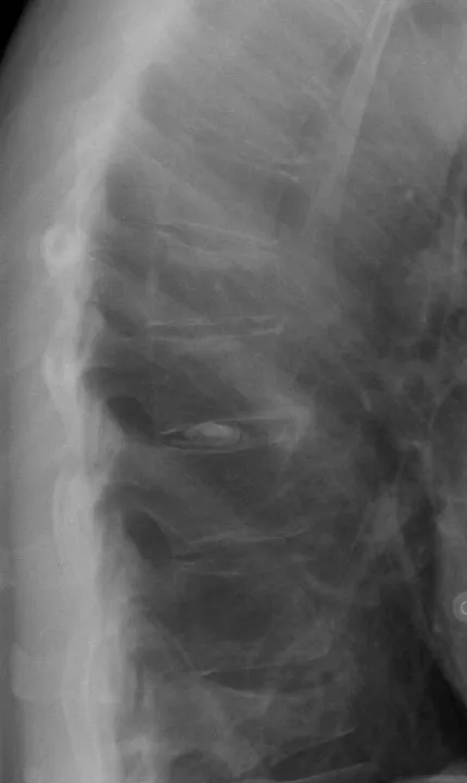 Lateral lower thoracic spine with a compression fracture of a vertebral body.