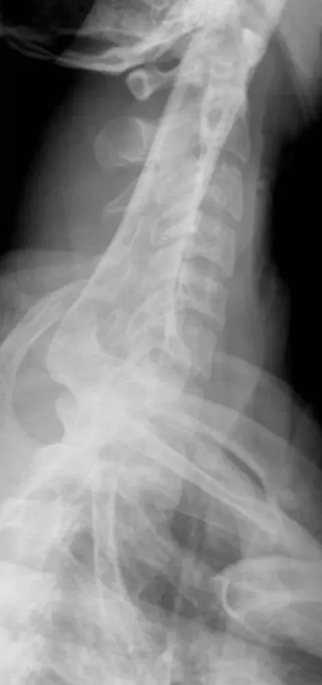 Swimmer's lateral showing C7 and the upper thoracic spine between the shoulders.