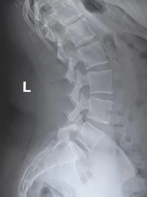 Lateral lumbar spine showing the lower lumbar levels and the L5–S1 joint.