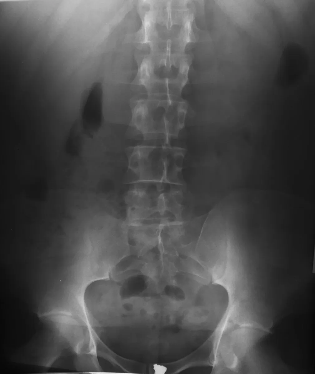 AP lumbar spine with the spinous processes in the midline and the sacroiliac joints included.